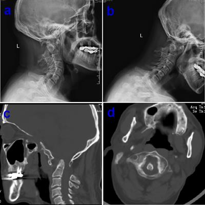 Precise Management of Chiari Malformation with Type I